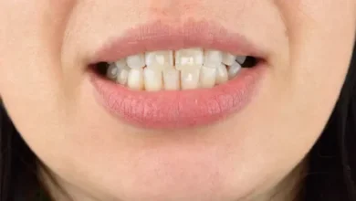 White Spots on Teeth: Do not take lightly the white spots on the teeth, here are the ways to get rid of them easily.