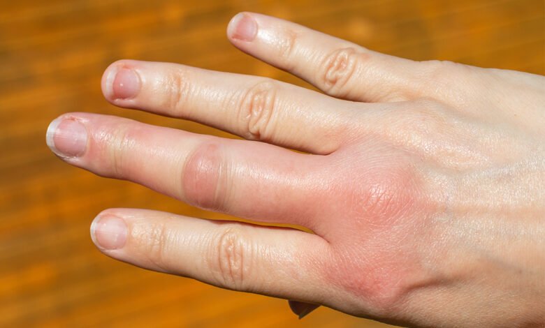 Fingers Swelling in Winter: Fingers are getting stiff or turning red in winter? So don't take it lightly